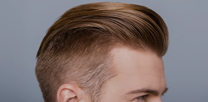 Intensiv schuppendes Haar